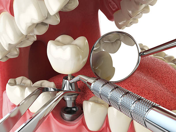 Best Emergency Denture Repair in Lowesville, NC
